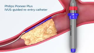 Philips Pioneer Plus IVUSguided reentry catheter [upl. by Smail]