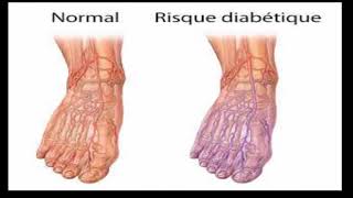comment soigner plaie pied diabétique Voici guérir un pied diabétique naturellement [upl. by Aztinaj]