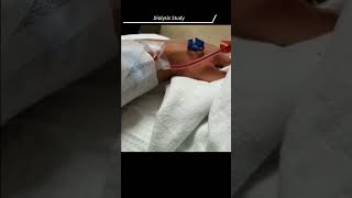 single needle dialysis  single needle cannulation [upl. by Eleazar511]