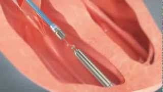 How to Insert a Tiny Wireless Pacemaker Into a Human Heart [upl. by Dal26]