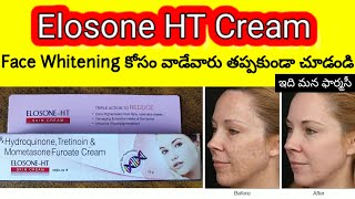 elosone ht cream uses in telugu  hyperpigmentation cream how to apply how many days precautions [upl. by Nhabois]