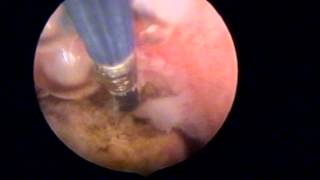 Resection Hystéroscopique de Polype Electrode Bipolaire 5 Fr [upl. by Ennaeirrac]