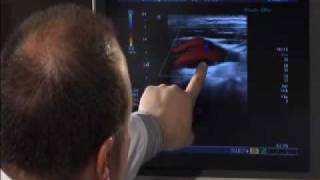 Carotid Artery Ultrasound [upl. by Obadiah]