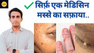 Best Medicine for warts  चेहरे के मस्सेगर्दन के मस्से DrJamil Ahmed Shah [upl. by Macintyre]