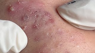 Acne Treatment Huong Da Nang 595  2024 [upl. by Htrowslle887]