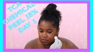 TCA Chemical Peel from MUAC Day One  Extreme Skincare [upl. by Aissac351]