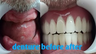 Removable complete denture [upl. by Ozzy]