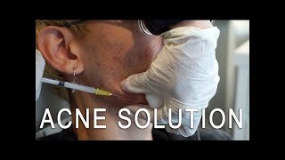 Cystic Acne Solution Kenalog Injection [upl. by Kalikow]