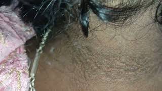 what are disease associated with acanthosis nigricans [upl. by Yelsa]