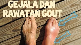 Gejala dan rawatan penyakit gout [upl. by Enidualc]