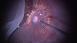 Vitrectomy for Giant retinal tear  Myopia  GRT  Retinal Detachment  Dr Manish Nagpal [upl. by Trinity376]