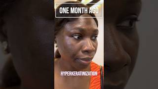 Meet Ms Adeola 🤩✨ who tackled HyperMelanosis with our Hyperpigmentation Treatment Protocol HTP✨ [upl. by Cyndia]