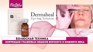 Коррекция грыжевых мешков верхнего и нижнего века препаратом Dermaheal Eyebag Solution [upl. by Enillebyam796]