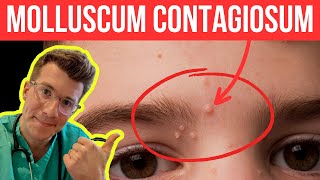 Doctor explains Molloscum Contagiosum viral skin infection  Causes symptoms and treatment [upl. by Nitsirhc]