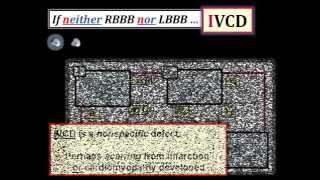 ECG Video2 Blog 96  BBB 83012014 [upl. by Anividul562]