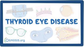 Thyroid Eye Disease causes symptoms diagnosis treatment pathology [upl. by Nakeber]