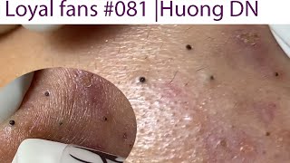 Acne Treatment Huong Da Nang 081  Loyal fans [upl. by Aldora]