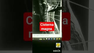 Anatomia Cisterna Magna [upl. by Vi114]