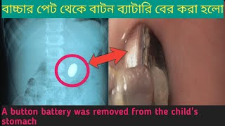 বাচ্চার পেট থেকে বাটন ব্যাটারি বের করা হলো A button battery was removed from the childs stomach [upl. by Dammahom741]