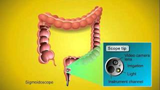 Colorectal Cancer Screening [upl. by Disario]