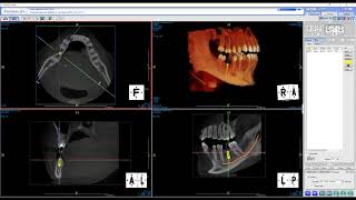 Prexion Excelsior implant placement [upl. by Alket]