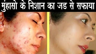 Remove Acne and Acne Scars from Root in 2 days How to get rid of acne scares in 2 Days [upl. by Flosser]