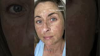 Melasma Can Be Cured With Hydroquinone Dermatologist Explains [upl. by Iggep]