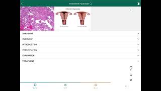 Endometrial Hyperplasia  فرط تنسج بطانة الرحم [upl. by Suiravaj]