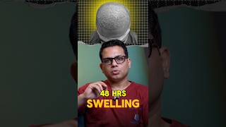 When does swelling go away after a hair transplant  Hair Transplant QnA Session by Dr Jangid [upl. by Eugatnom922]