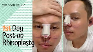 Rhinoplasty In the Philippines 1st Day Post Opp [upl. by Krisha]