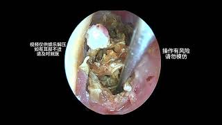 Cleaning a large amount of earwax that severely blocks the ear canal earwaxremoval earwax cleaning [upl. by Koval965]