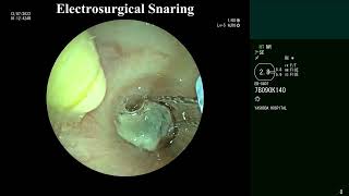 Rigid bronchoscopy  Tumor Debulking  Electrosurgical  Renal Cell Carcinoma airway metastasis [upl. by Haidedej]