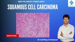 Squamous Cell Carcinoma I FMGE I NEET Pg I USMLE I PLAB I INICET I MRCP [upl. by Elaynad]