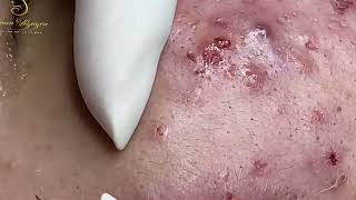 Loan Nguyen Acne Treatment 1611h [upl. by Neeruan]