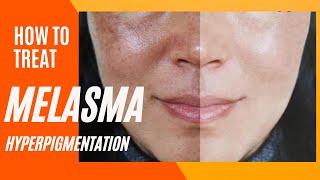 Melasma Removal at Home I Melasma Remove cream I Melasma Skin Care Regimen Routine [upl. by Luapnaes]