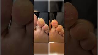 Discover relief with Aussie Expert Watch our Corn amp Callus removal from a 2nd toe [upl. by Zantos775]