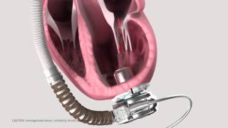 HeartWare® Ventricular Assist System animated demonstration [upl. by Natka]