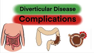 Complications of Diverticular Disease [upl. by Refennej]