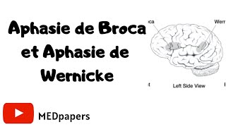 Wernickes VS Brocas Aphasia [upl. by Orsini]