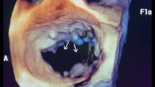 Flail mitral valve to drahmadmirdamadisib0x4hbGYPGj0htw [upl. by Wehner]