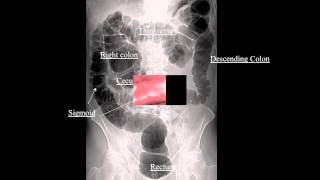 UCSF Radiology Inflating the Colon for Better View [upl. by Alexandro]