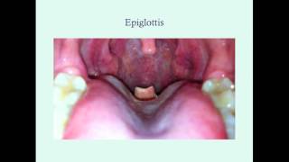 Epiglottitis  CRASH Medical Review Series [upl. by Terzas]