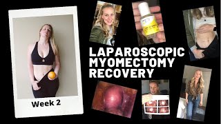 Laparoscopic Myomectomy Recovery Week 2 [upl. by Mittel]