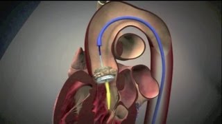 Transcatheter Aortic Valve Implantation TAVI [upl. by Melburn]