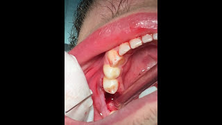 How to pull a broken tooth  First Molar extraction  قلع جراحي [upl. by Akinohs]