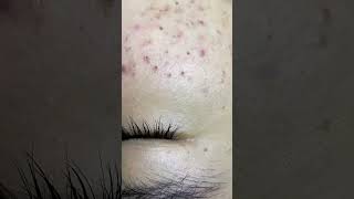 Blackhead Removal Acne Removal Treatment 06 [upl. by Eseret]