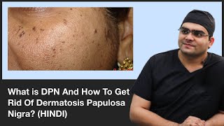 5 Facts about Dermatosis Papulosa Nigra  What are DPN’s  Dr Divya SharmaDoctors Circle [upl. by Aim]