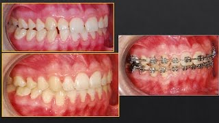 Molar DistalizationVery Good Orthodontics [upl. by Chafee]