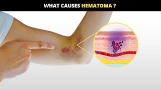 Hematomas Causes Symptoms Solutions [upl. by Edrick]