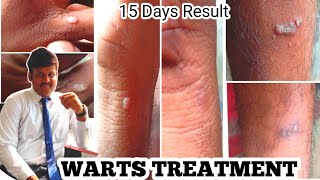 warts remove in tamil  wart remover in tamil  wart removal in tamil  DR BALAJIMUTHU [upl. by Nirej]